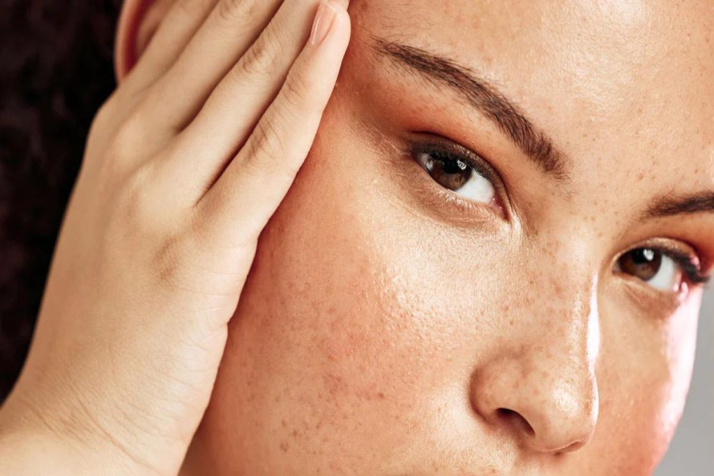 BlackHeads- Causes, and Steps to Remove