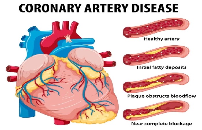 Coronary Artery Disease 