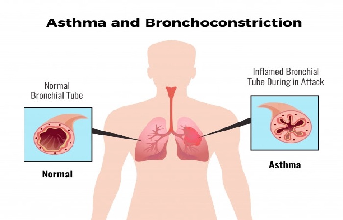 Causes of Asthma