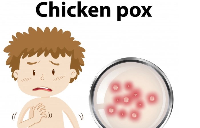 causes Chickenpox