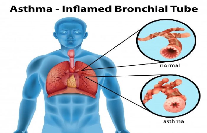 forms of Asthma