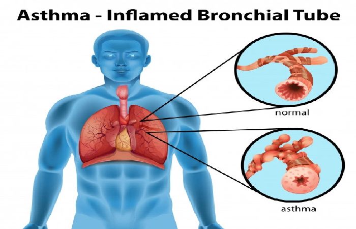 forms of Asthma