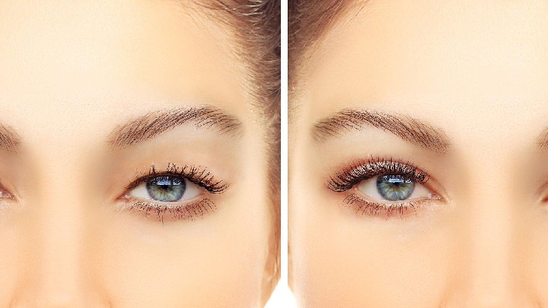 What Causes Eye Puffiness?